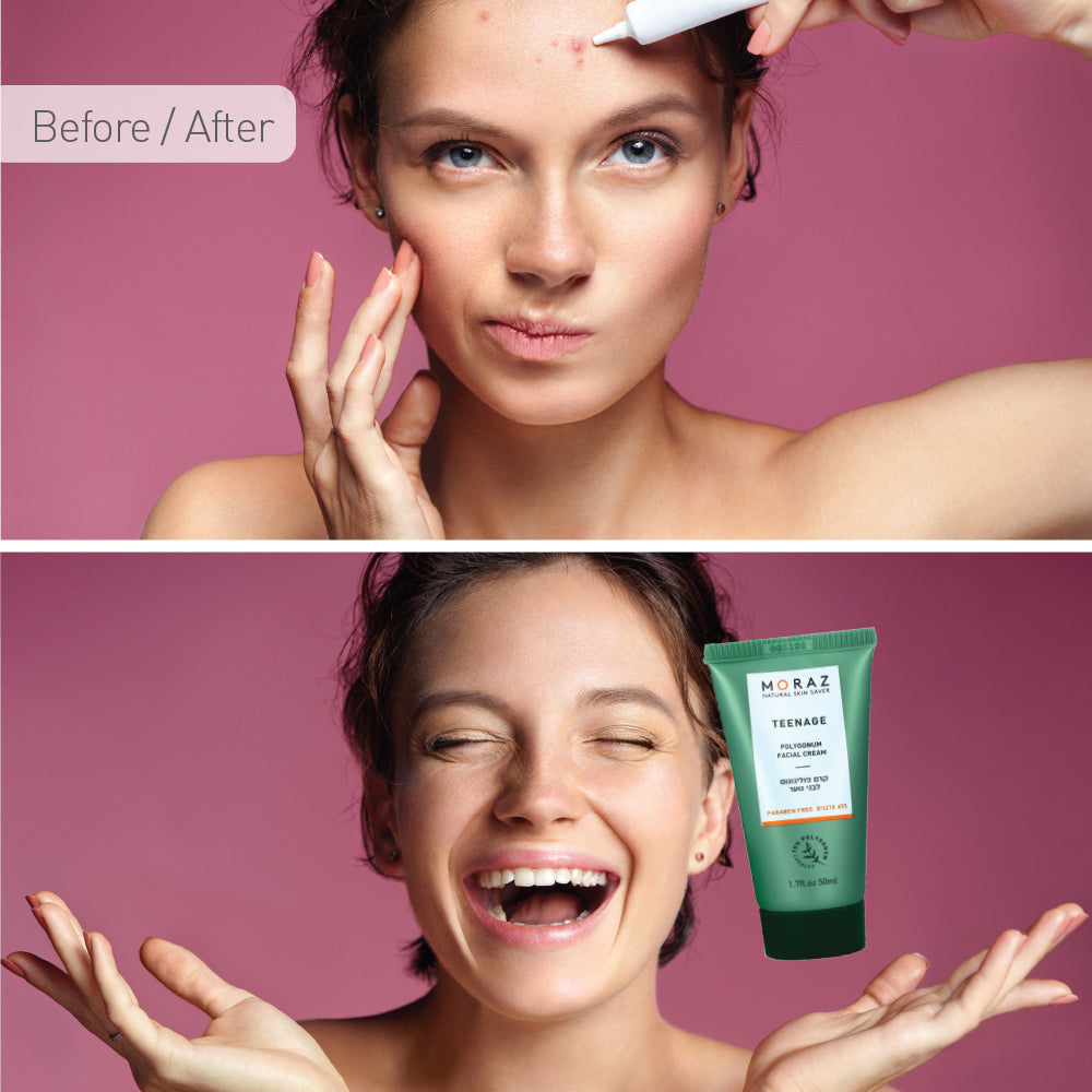 痘痘靈 Polygonum Teenage Facial Cream